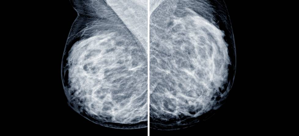 Breast Cancer Surgery