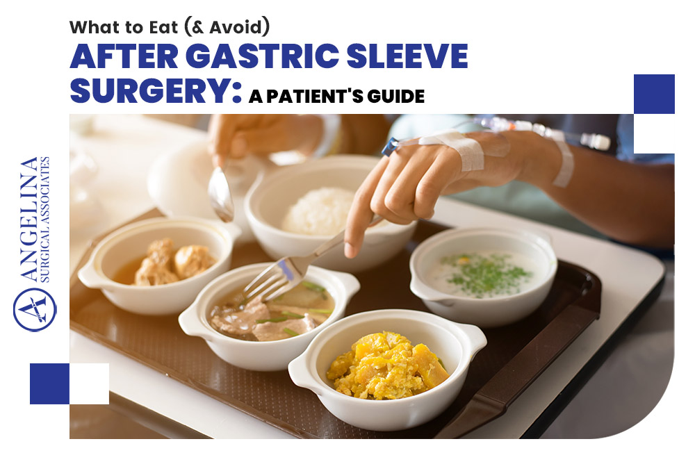Gastric Sleeve Surgery