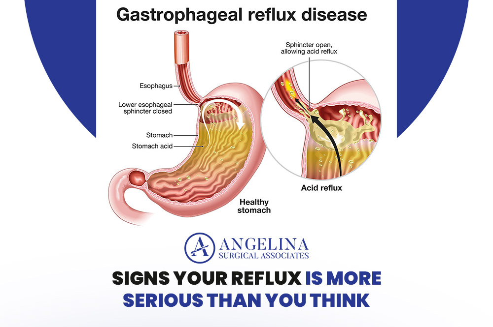 Reflux