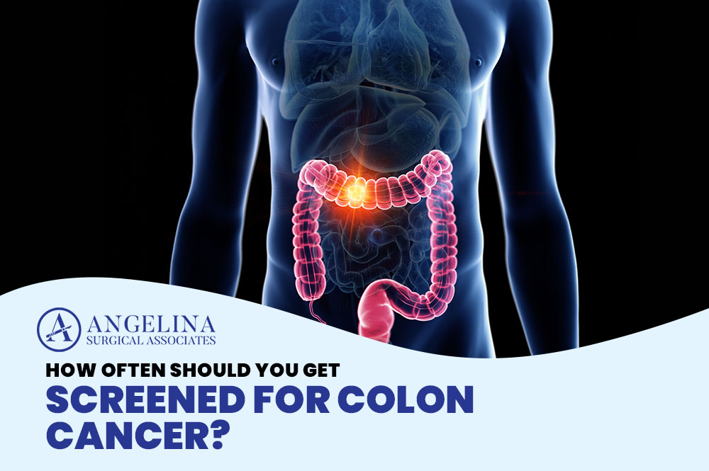 Colon cancer